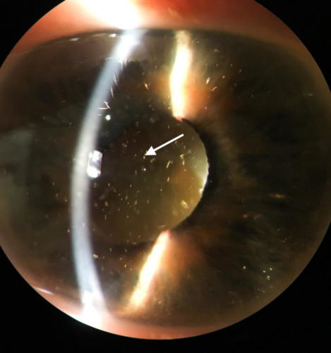 Cholesterol crystals in the anterior chamber - probably